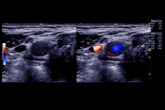 Beinvenenthrombose Diagnostik