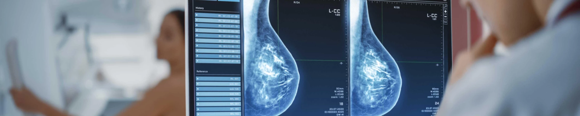 Mammographie 