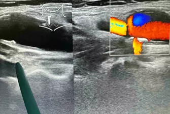 pAVK Diagnostik