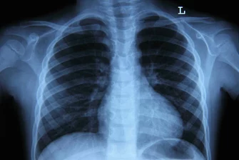 Interpretation Röntgen Thorax