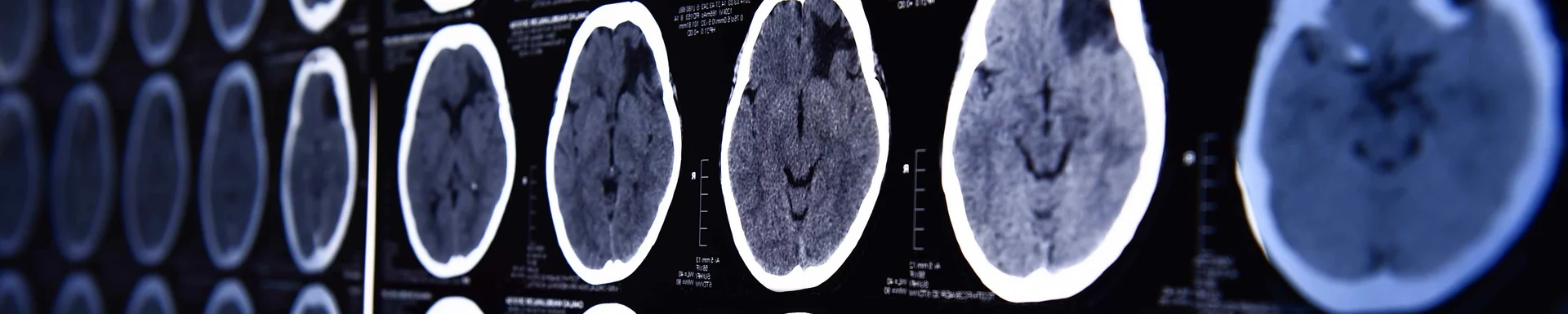 Neurologie Neuroradiologie CT Gehirn