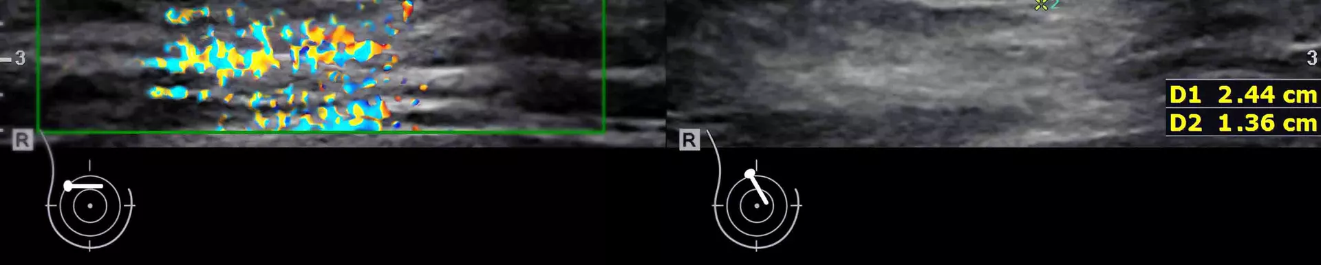 Brustdrüse Ultraschall POCUS